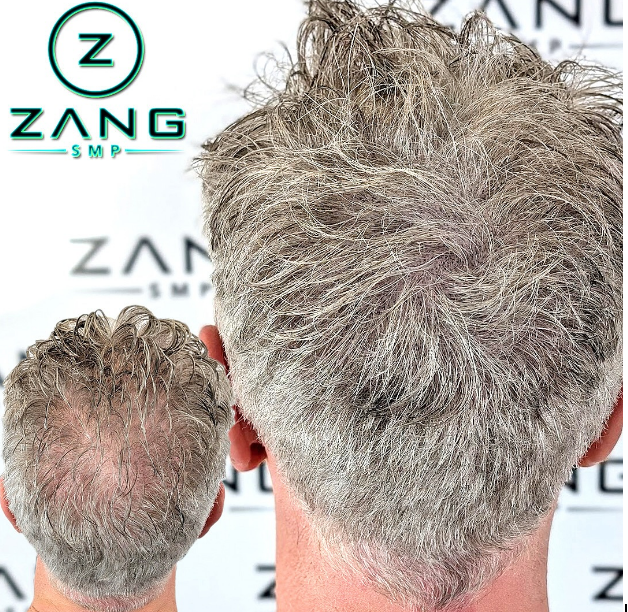 Thicker Hair, No Surgery: SMP Treatments in Dallas