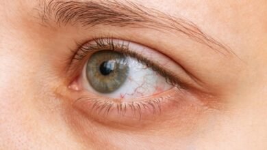 Dry Eye Syndrome