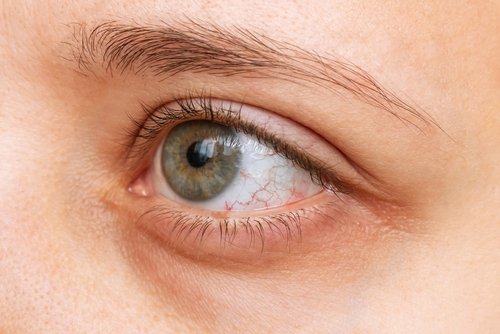 Dry Eye Syndrome