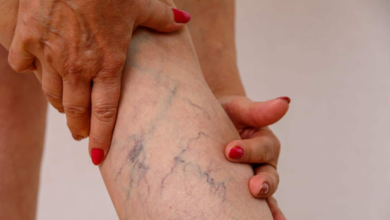 Varicose Veins