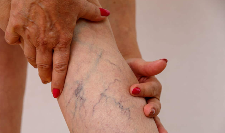 Varicose Veins