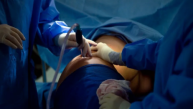 Understanding Liposuction in Calgary: What You Need to Know Before Your Procedure