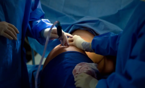 Understanding Liposuction in Calgary: What You Need to Know Before Your Procedure