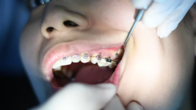 Affordable Braces: What To Expect During Your Treatment Journey 