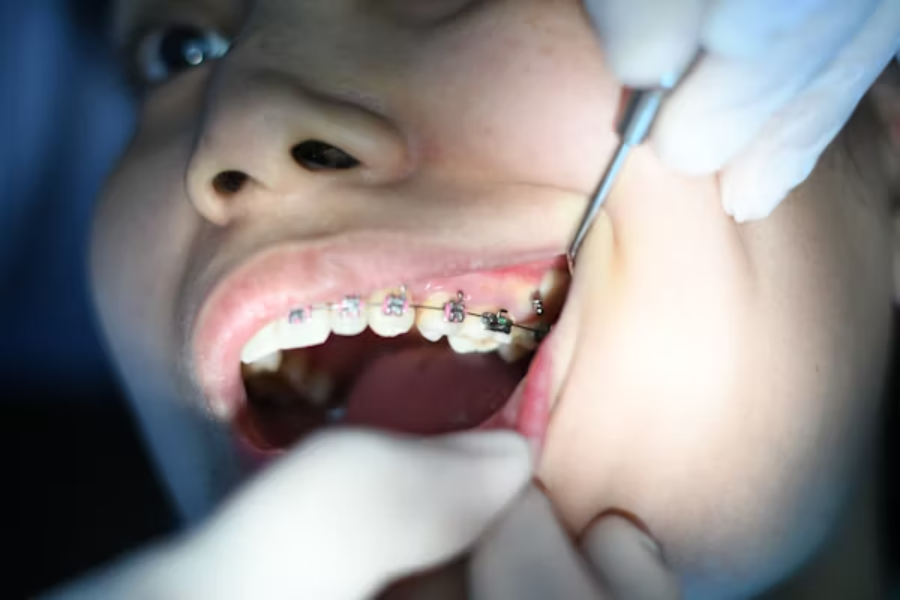 Affordable Braces: What To Expect During Your Treatment Journey 