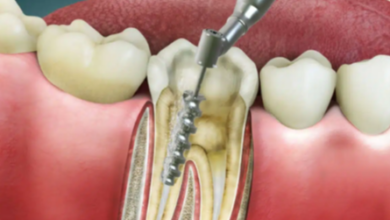 Root Canal Retreatment | Reasons Signs and Procedure