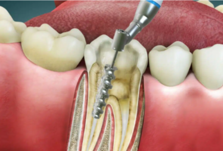 Root Canal Retreatment | Reasons Signs and Procedure