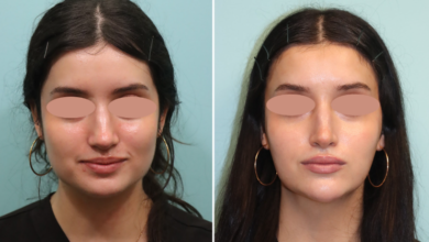 Is Jaw Botox Right for You? Key Factors to Know