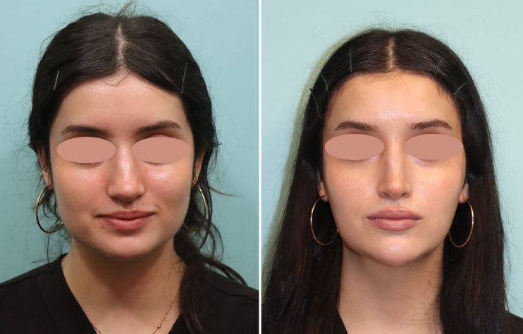 Is Jaw Botox Right for You? Key Factors to Know